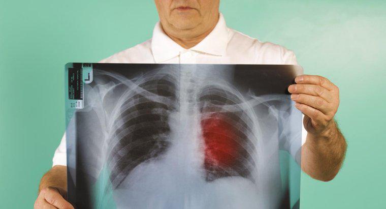 Qual é o prognóstico para o câncer de pulmão no estágio três?