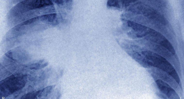 O que é linfoma pulmonar?