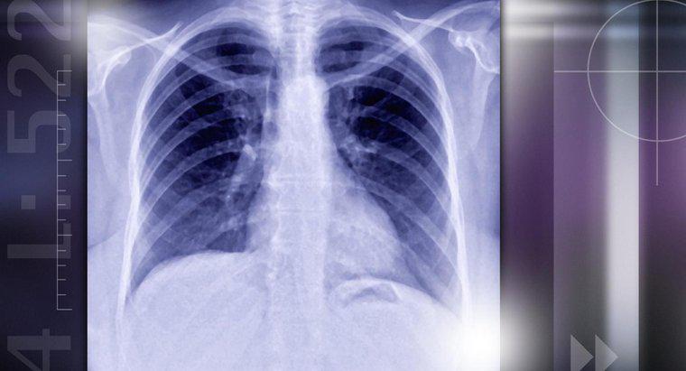 O que causa os nódulos pulmonares?
