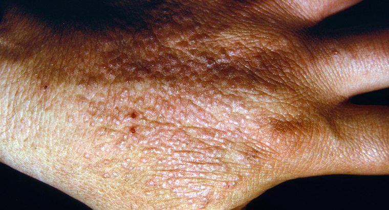Como as pessoas entram em contato com a dermatite?