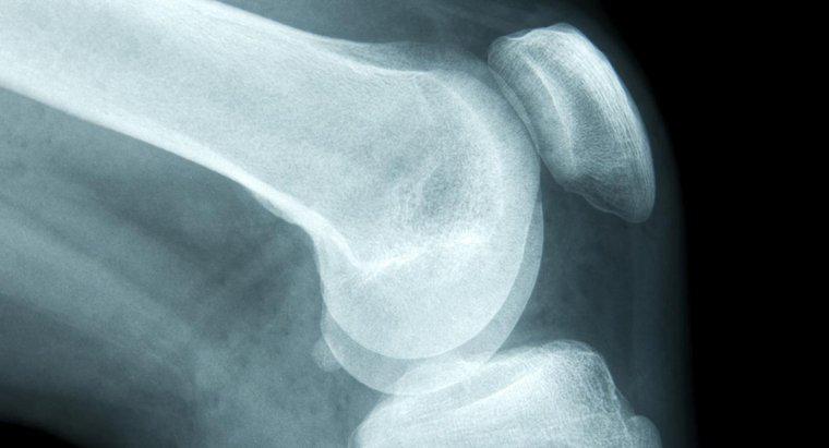 Quais são os primeiros sintomas de câncer ósseo?