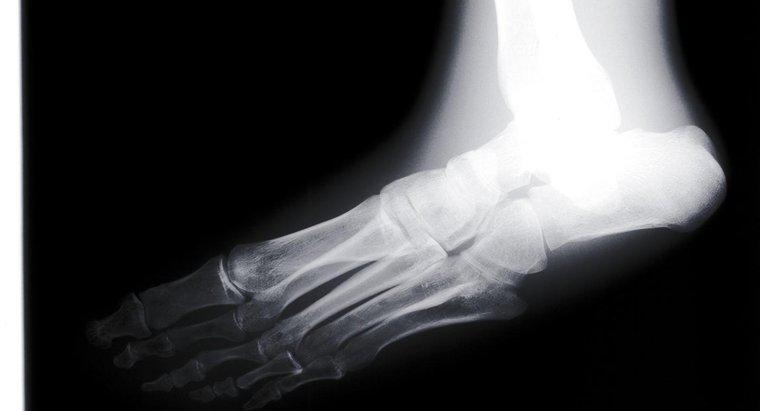 Como você pode consertar pés planos com tratamento?