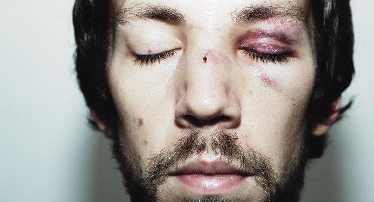 Como fazer feridas no rosto para cicatrizar mais rápido?
