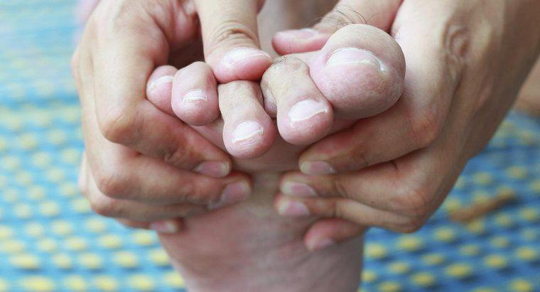 Como você alivia a dor dos calos entre os dedos dos pés?