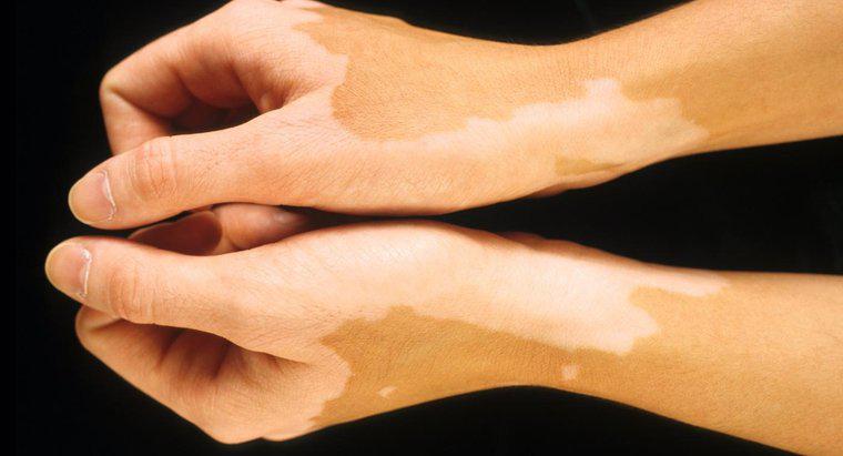 Quais são os tipos de doenças de descoloração da pele?