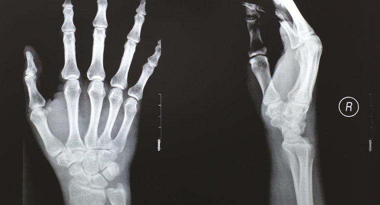 Quais são os sintomas de um polegar quebrado?
