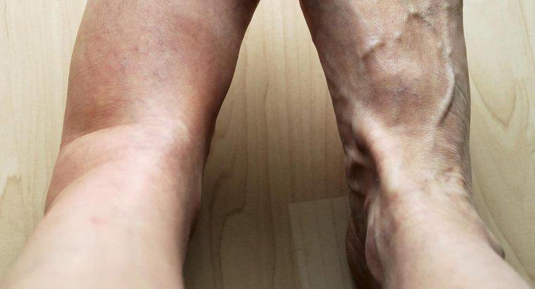 Quais são as possíveis causas de dor e inchaço na perna esquerda?