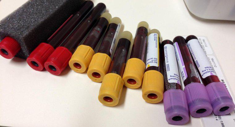 O que medem os níveis de ferritina em um exame de sangue?