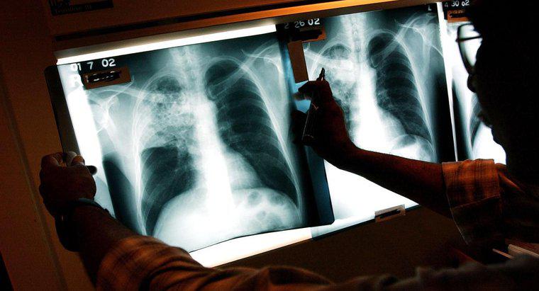 Quais são os efeitos a longo prazo da tuberculose?