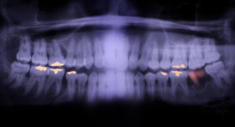 Um dente ruim pode deixá-lo doente?
