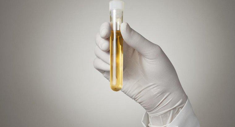 O que significa quando você tem alto teor de proteína na urina?