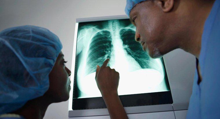 Quais são os sintomas exclusivos do câncer de pulmão?