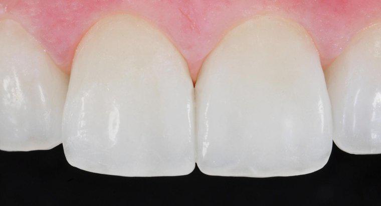 As facetas dentais são cobertas por seguro?