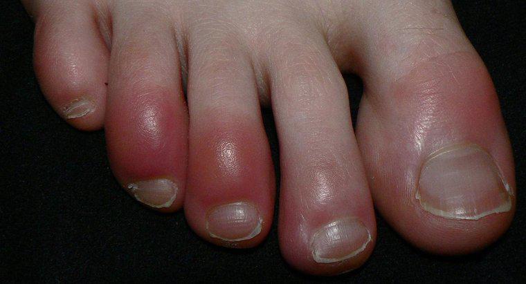 Os dedos do pé vermelhos são um sintoma da síndrome de Raynaud?