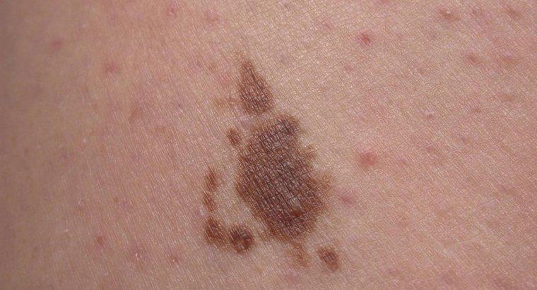 O que são manchas solares na pele?