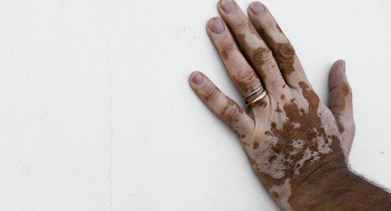 Como você se livra da descoloração da pele?