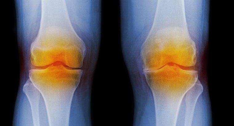 Quais são os sintomas da artrite no joelho?