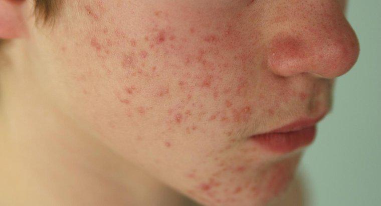 O hipotireoidismo causa acne?
