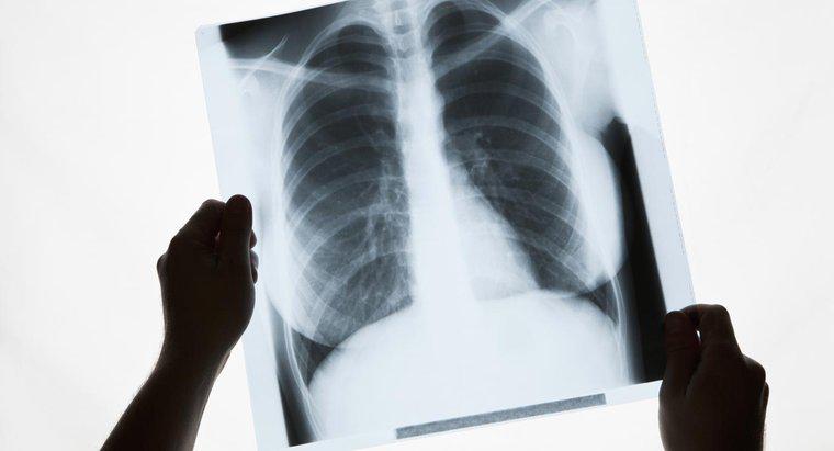 O que causa manchas brancas nos pulmões?