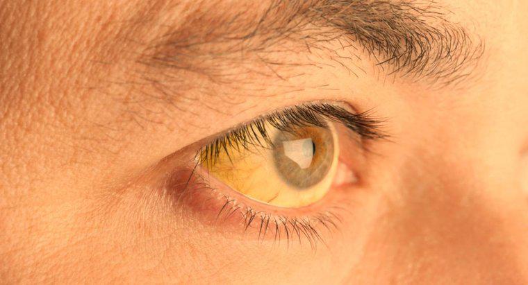 O que faz com que a pele sob os olhos fique amarela?