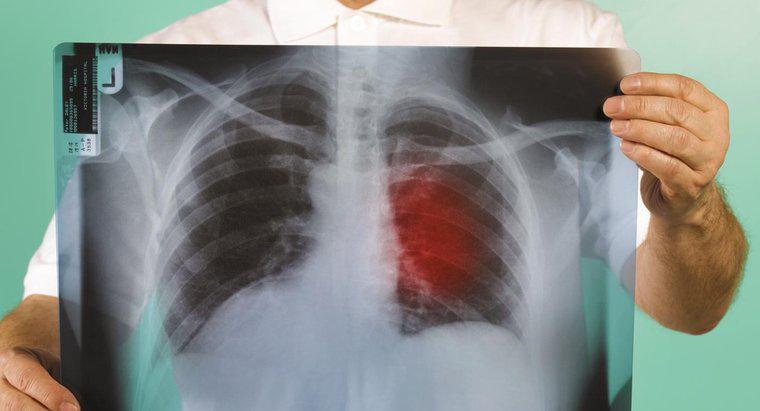 Quais são os primeiros sinais de câncer de pulmão?