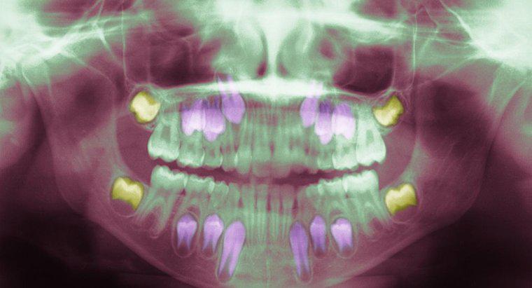 O que causa uma infecção do dente do siso?